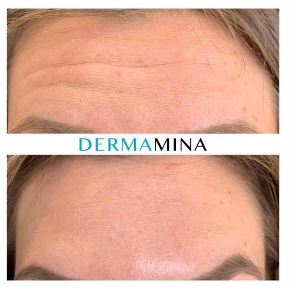 Anti Wrinkle Treatments Cost Price Guide