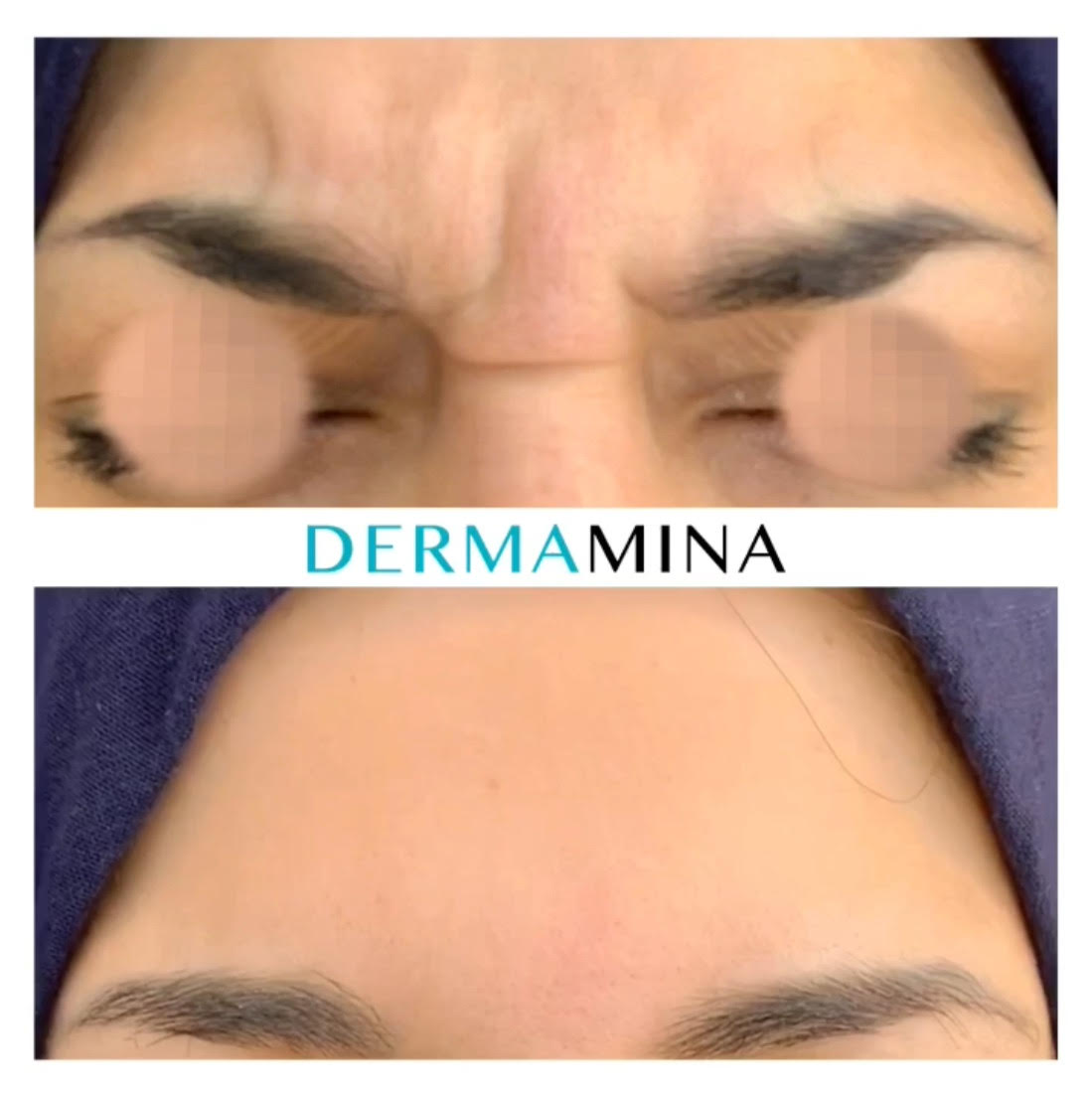 Eyebrow Lift Cost Price Guide