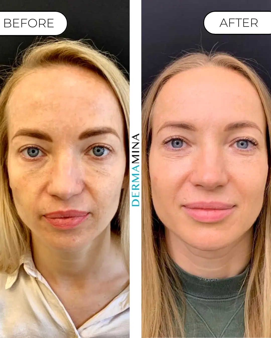 Before and After