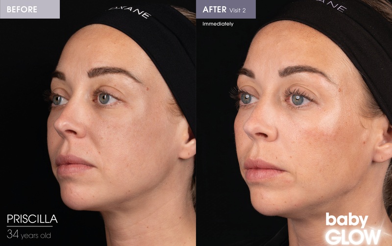 Before and After