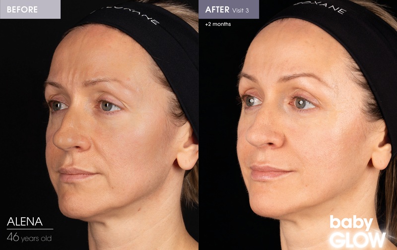 Before and After