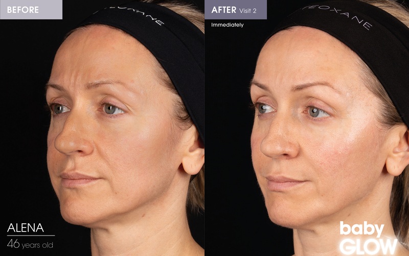 Before and After