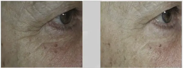Before and After