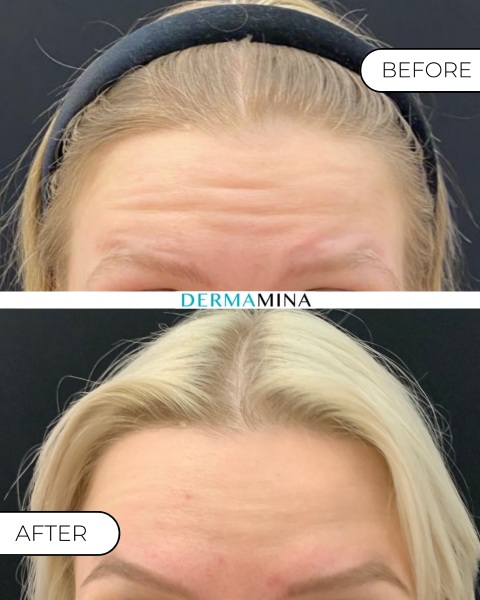 Everything About Botox