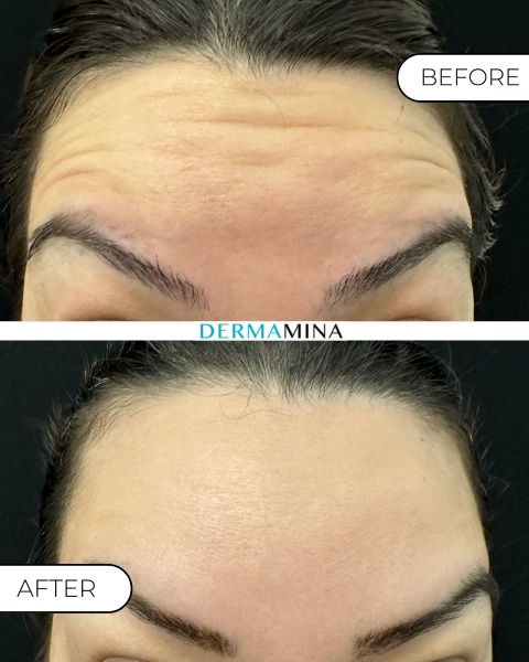 Eyebrow Lift Results Timeline
