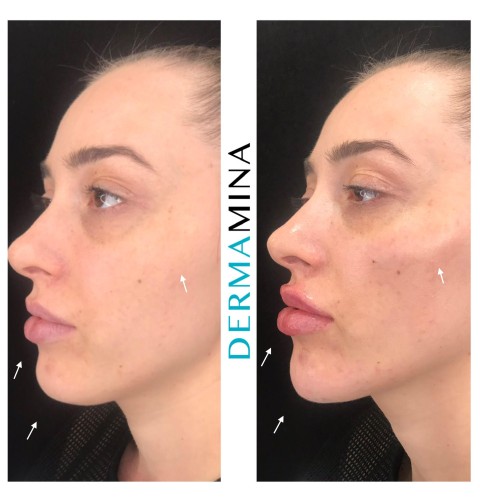 Chin filler treatment