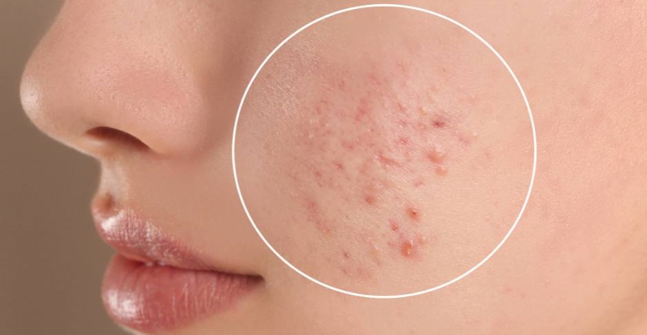 Acne Peels