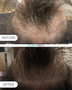 Before and After