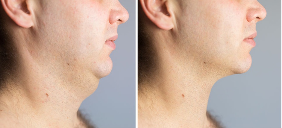 Before and After