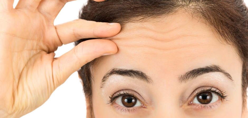Forehead lines treated with dermal filler at Dermamina London