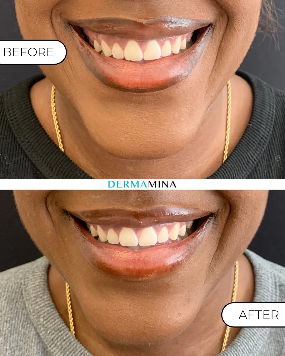 Gummy Smile
