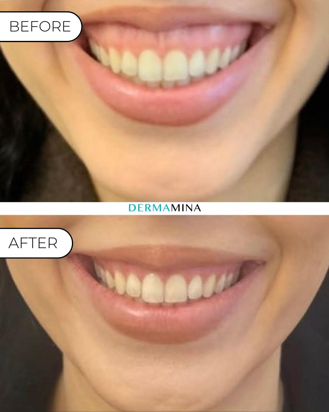 Before and After