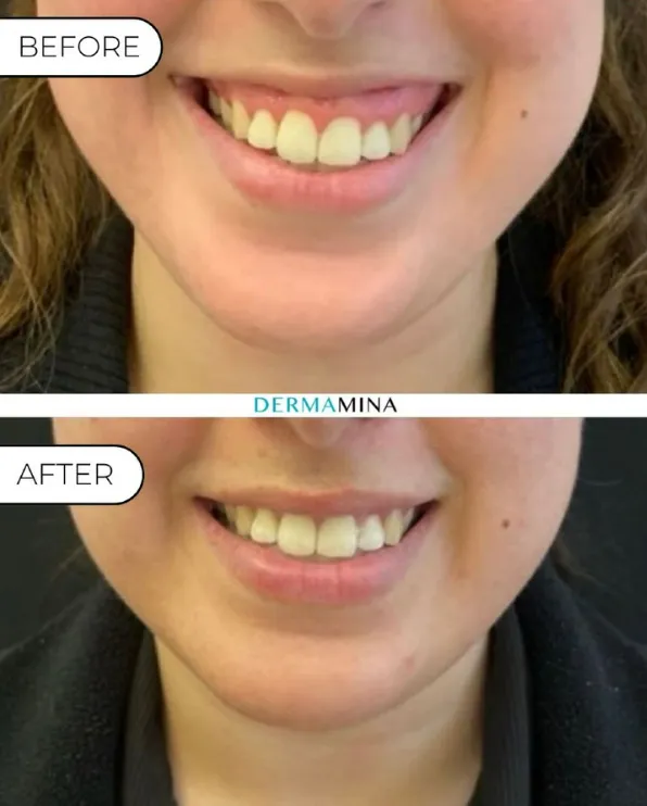 Before and After