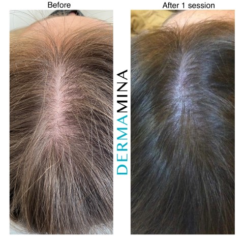 Does Mesotherapy For Hair Work