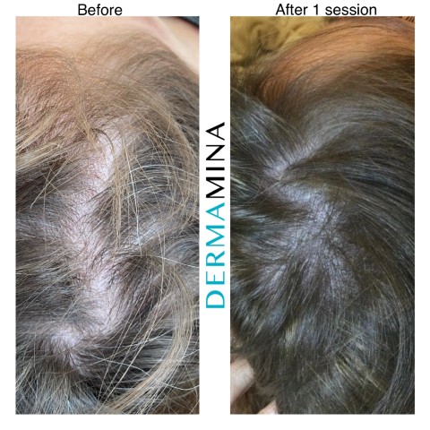 Exosomes Hair Loss Cost Price Guide