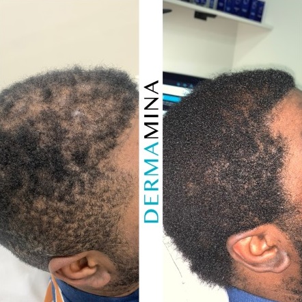 Before and After