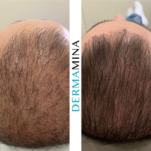 Before and After