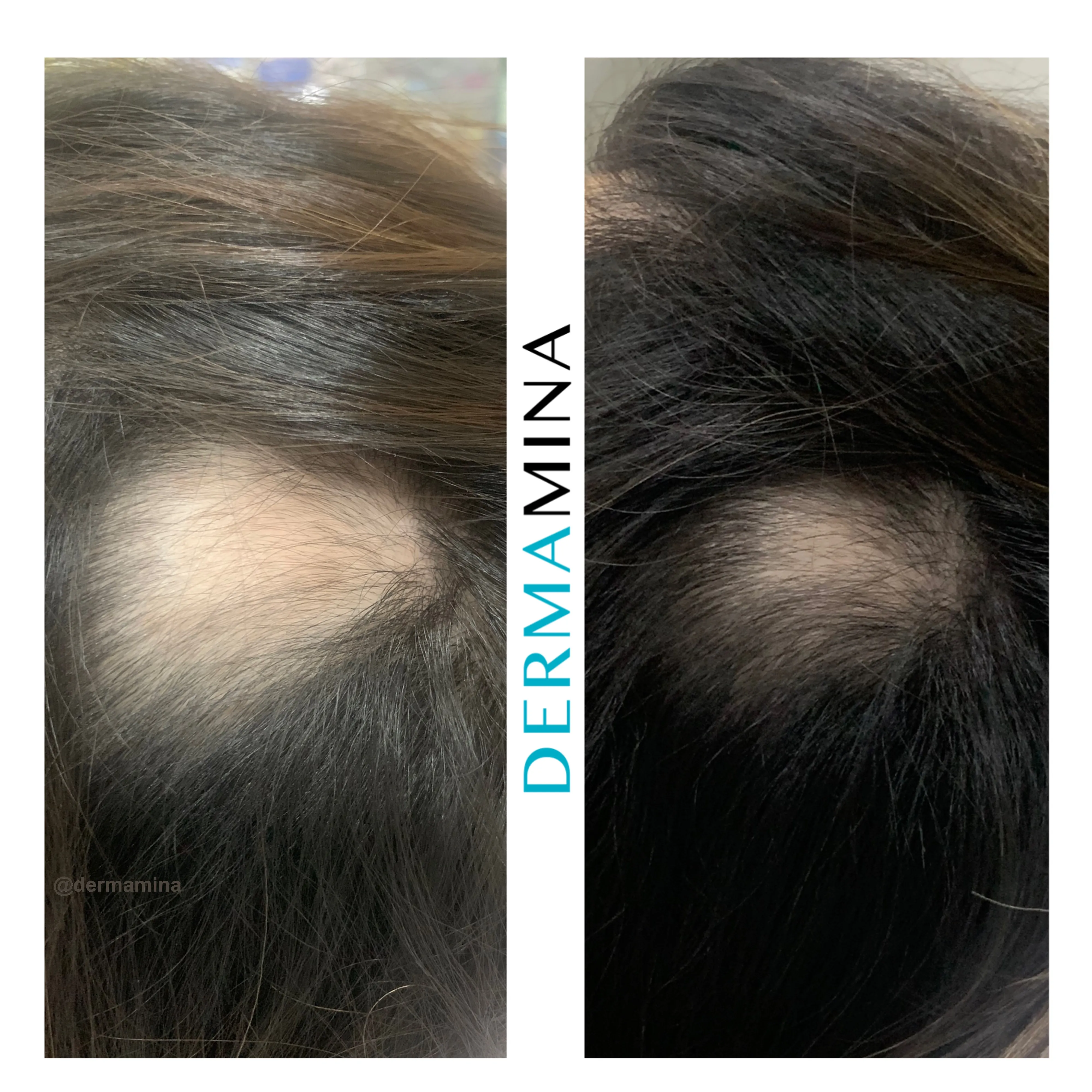 PRP - The Best and Most Effective Hair Restoration Solution — Dermamina blog