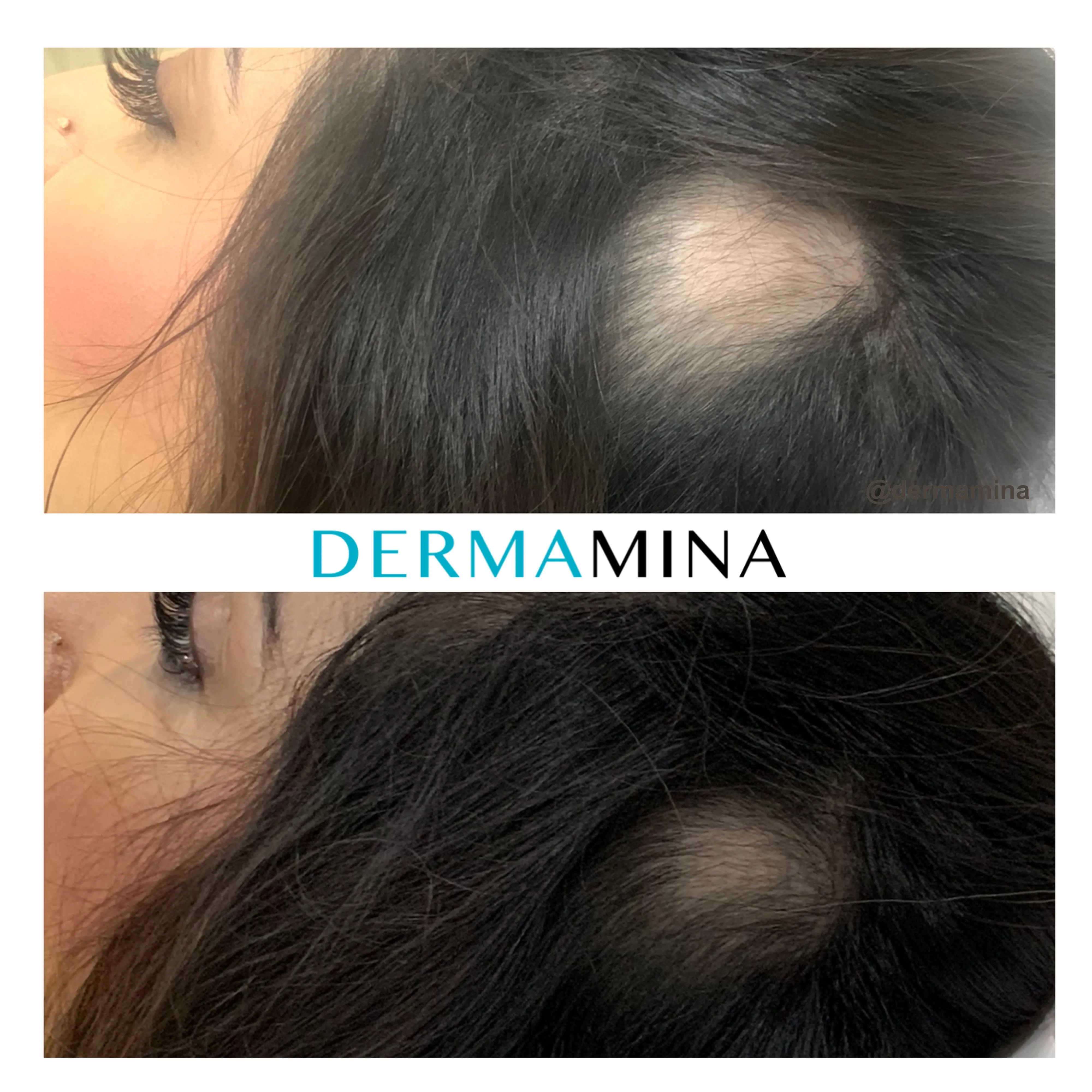 PRP Therapy for Hair Loss - The Number One Choice Compared to Other Alternatives — Dermamina blog