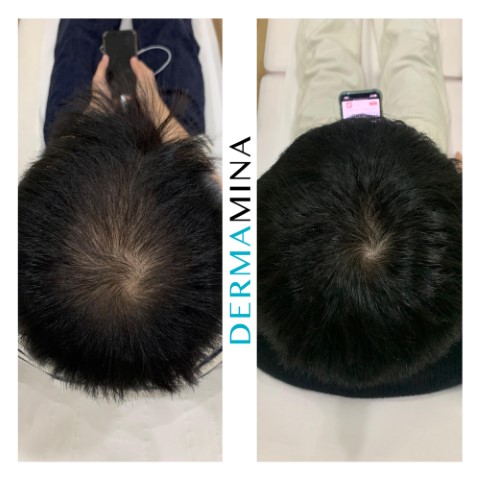Mesotherapy Hair Cost Price Guide
