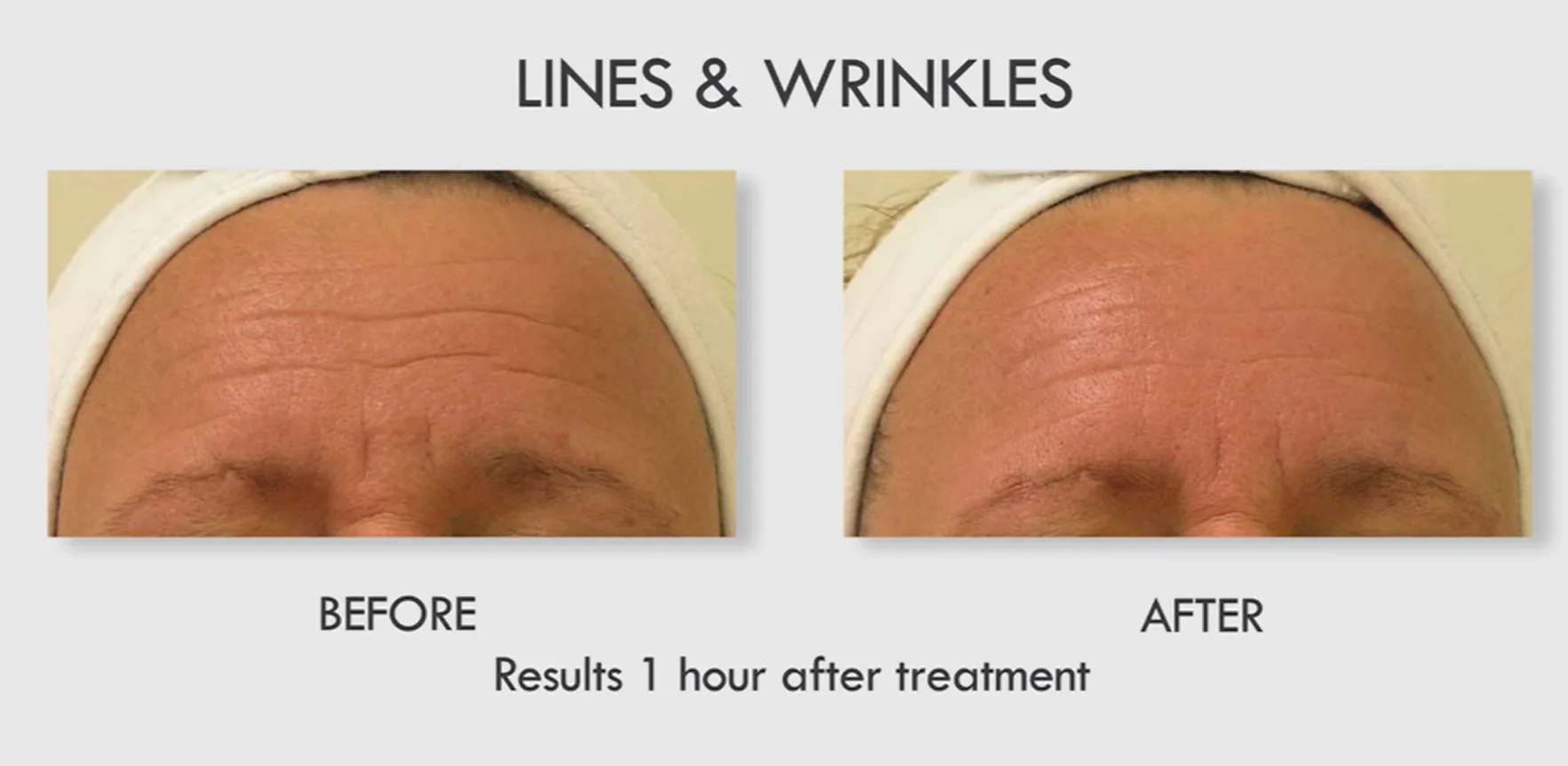 Hydrafacial Results Timeline