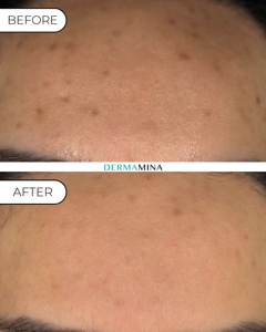 Before and After