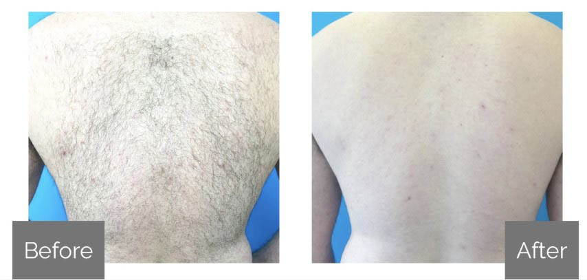 Before and After