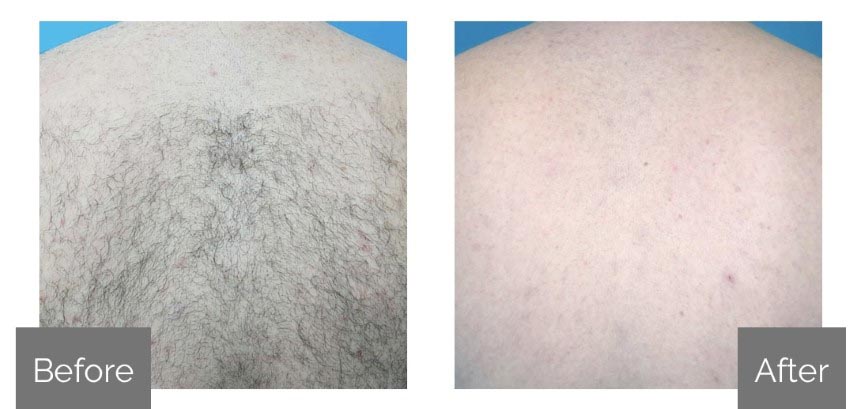 Before and After