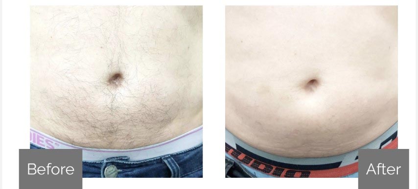 Before and After