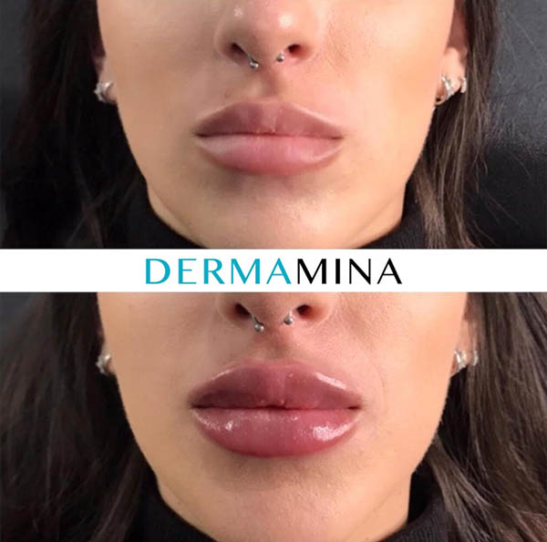 Lack of Lip Volume