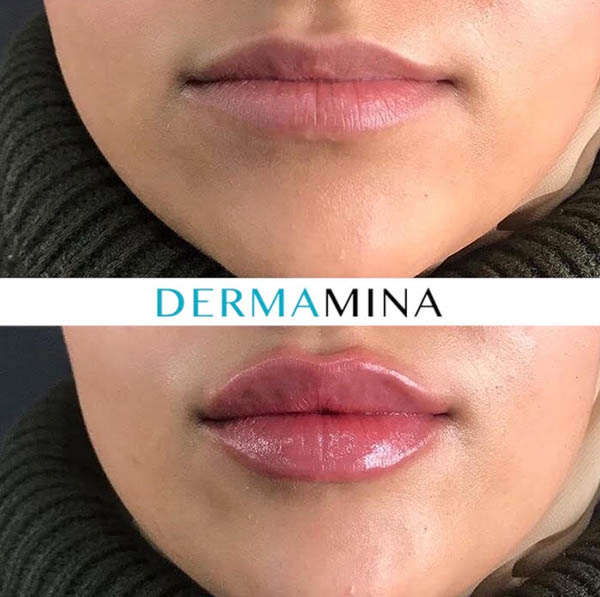 Lip filler result 10