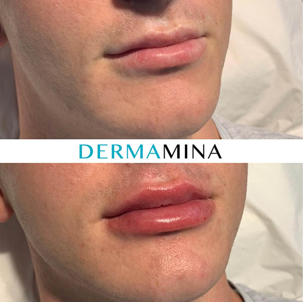 M Shaped Lips