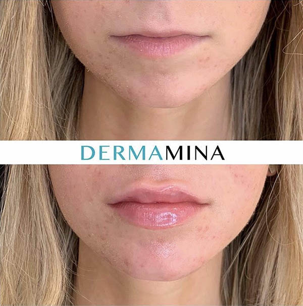 Asymmetric Lips