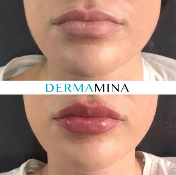 Lip filler result 9