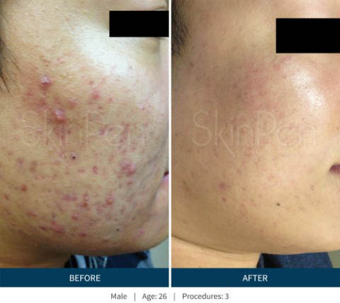 Before and After