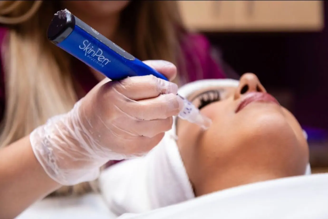 Microneedling