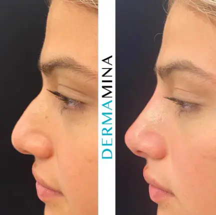 Non-surgical nose job before and after at Dermamina London, result 4