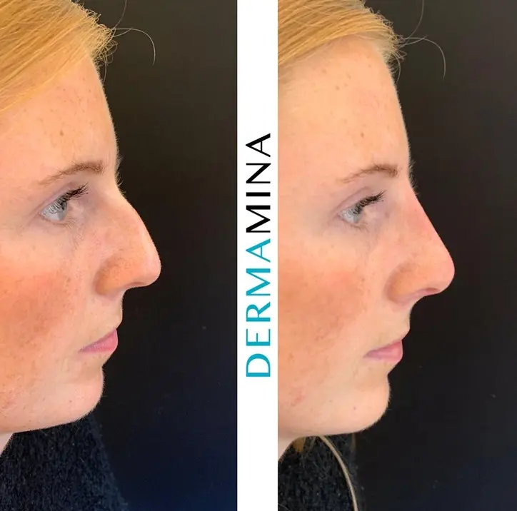 Non-surgical nose job before and after at Dermamina London, result 26