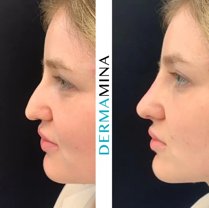 Non-surgical nose job before and after at Dermamina London, result 27