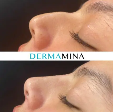 Non-surgical nose job before and after at Dermamina London, result 28