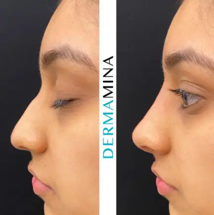 Non-surgical nose job before and after at Dermamina London, result 29