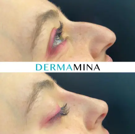 Non-surgical nose job before and after at Dermamina London, result 30