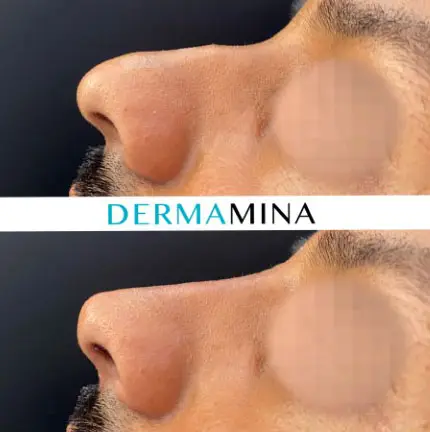 Non-surgical nose job before and after at Dermamina London, result 32