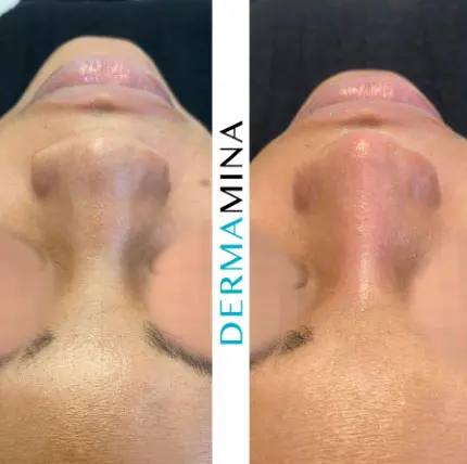 Non-surgical nose job before and after at Dermamina London, result 33