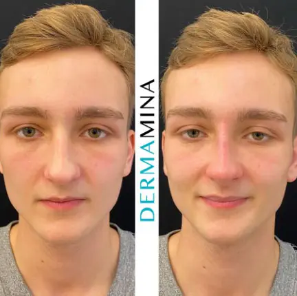 Non-surgical nose job before and after at Dermamina London, result 34
