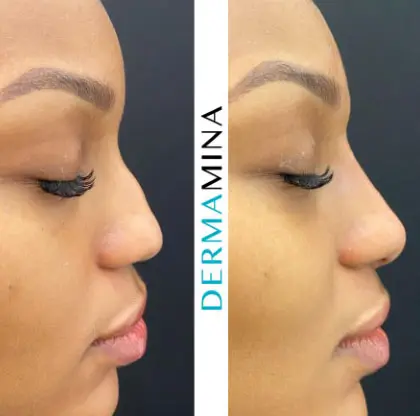 Non-surgical nose job before and after at Dermamina London, result 35