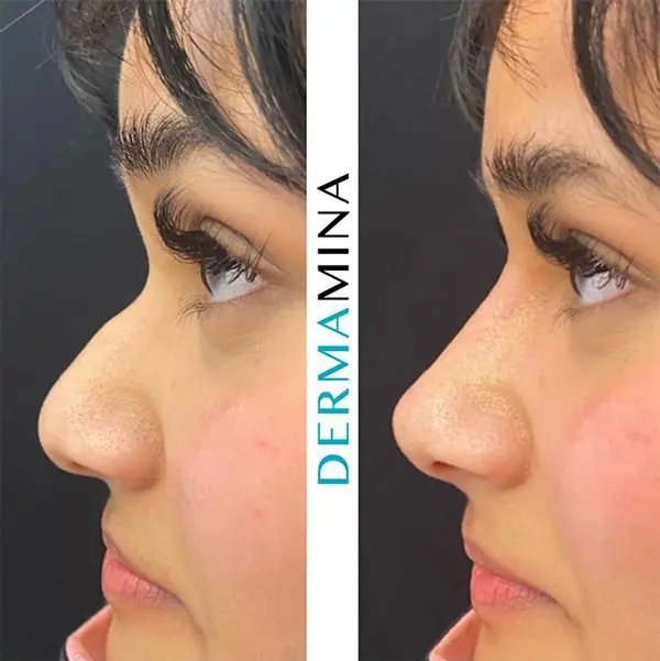 Non-surgical nose job before and after at Dermamina London, result 3