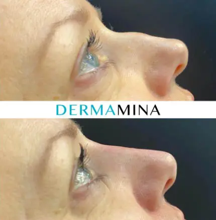 Non-surgical nose job before and after at Dermamina London, result 36