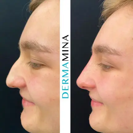 Non-surgical nose job before and after at Dermamina London, result 37