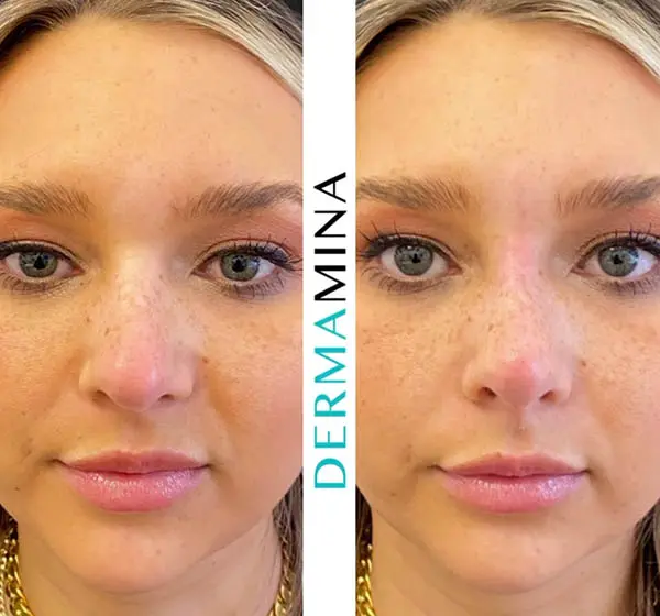 Non-surgical nose job before and after at Dermamina London, result 5